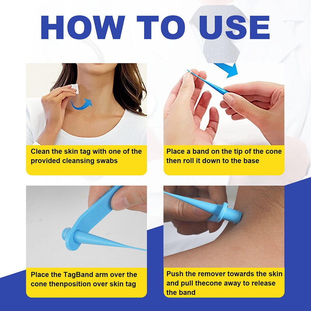 "Home skin tag removal kit with tools for gentle ligation technique, suitable for small to medium skin tags, easy and safe us