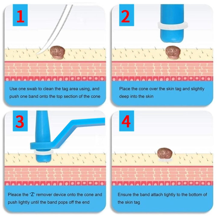 "Home skin tag removal kit with tools for gentle ligation technique, suitable for small to medium skin tags, easy and safe us