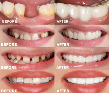 "Men's EasyClick Denture Prosthesis for a natural, confident smile; easy application, reusable, glue-free fit."