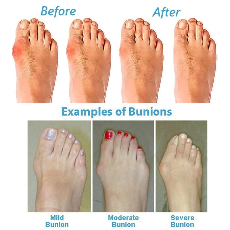 Orthopedic women's sandals for bunion relief. Features adjustable straps, wide fit & arch support for healthy, comfy feet.